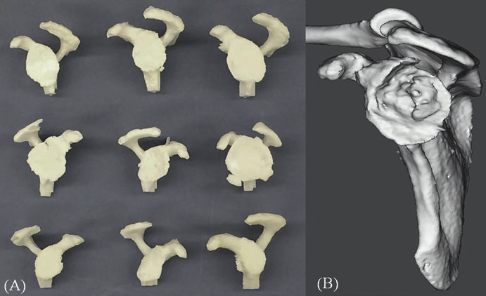 3D Printing For Shoulder Surgery