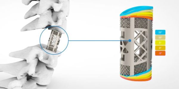 Farsoon Metal 3D Printing Technology Used For Approved Medical Implants ...