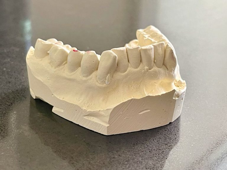 The Dental Dilemma: Why Some Dentists Aren’t Embracing 3D Printing