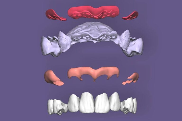 Review Highlights 3D Printing In Removable Prosthetics